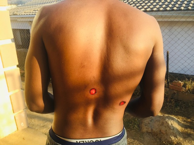 Photo of a man's back with rubber bullet wounds